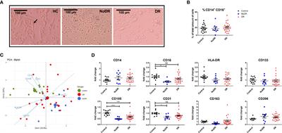 Aberration in myeloid-derived pro-angiogenic cells in type-2 diabetes mellitus; implication for diabetic retinopathy?
